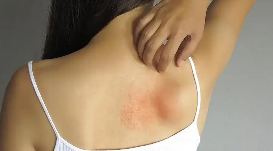 खाज सुटणे आणि रिंगवर्मपासून आराम मिळविण्यासाठी प्रभावी घरगुती उपाय
