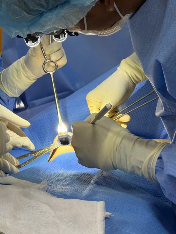 इम्प्लांट पॉकेट डिसेक्शन. डॉ. हो काओ वू यांचे फोटो सौजन्याने