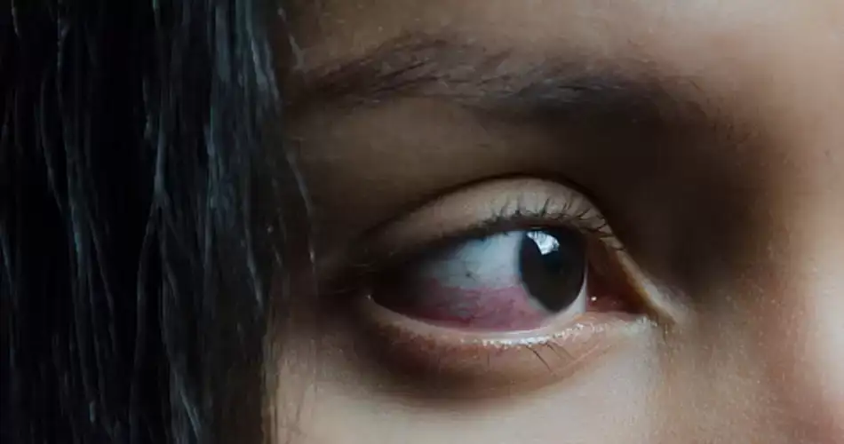 डोळ्यात पाणी येण्याच्या समस्येवर घरगुती उपाय