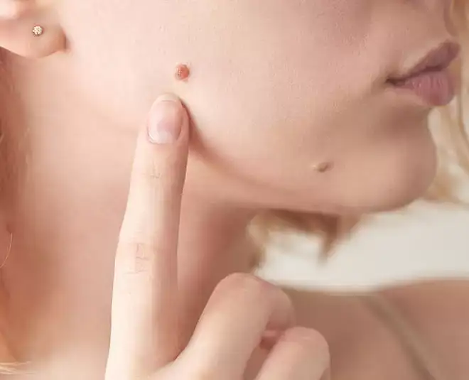 घरगुती उपायांनी चामड्यांपासून मुक्ती मिळवण्याचे सोपे उपाय