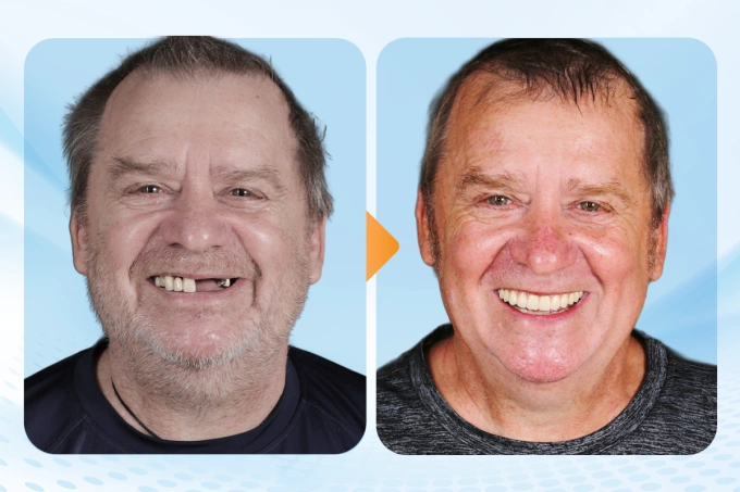 HCMC मधील डॉ. केअर इम्प्लांट क्लिनिकमध्ये इम्प्लांट उपचार पूर्ण करण्यापूर्वी आणि नंतर नॉर्बर्ट एबरहार्ट. फोटो सौजन्याने डॉ.केअर