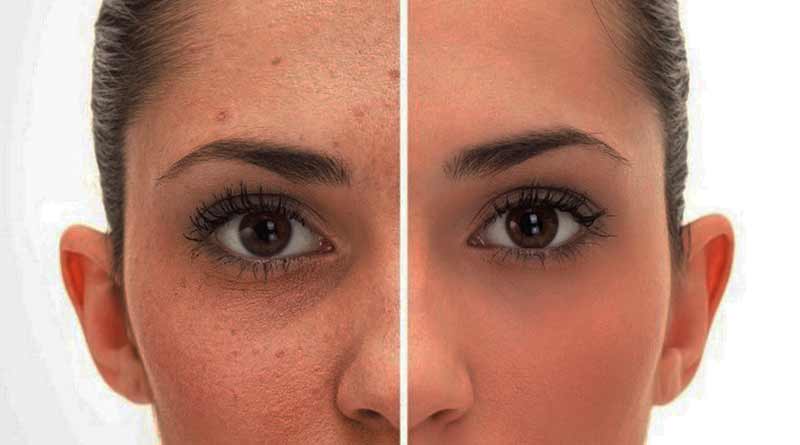 त्वचेवर निळ्या प्रकाशाचा प्रभाव डिजिटल वृद्धत्व आणि सुरकुत्या निर्माण करतो
