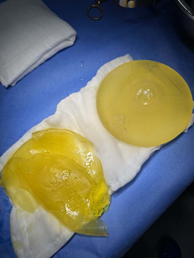 टेक्सचर ब्रेस्ट इम्प्लांट 8 वर्षांनी फुटणे. फोटो सौजन्याने डॉ. हो काओ वू